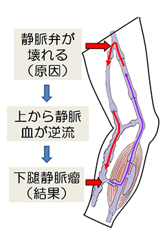 大阪中央病院 診療科のご紹介 皮膚 形成外科 下肢静脈瘤
